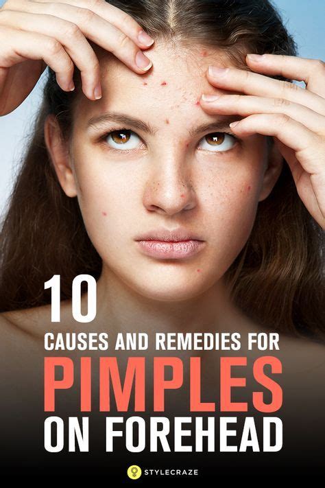 How To Get Rid Of Pimples On Forehead | Pimples on forehead, Pimples ...