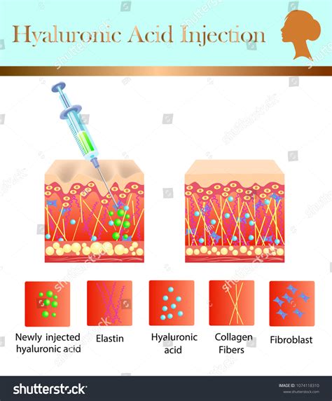 Hyaluronic Acid Injection Before Affect Vector Stock Vector (Royalty ...