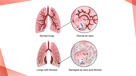 Understanding PF | PulmonaryFibrosis360.com