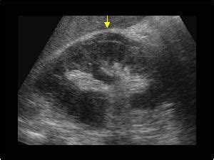 Perirenal abscess longitudinal