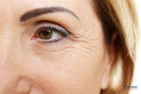 Are There Different Types Of Wrinkles? | Epiphany Dermatology