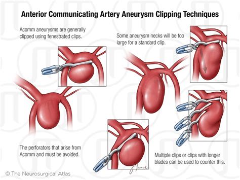 Anterior Communicating Artery Aneurysm Clipping - jtsciencevisuals