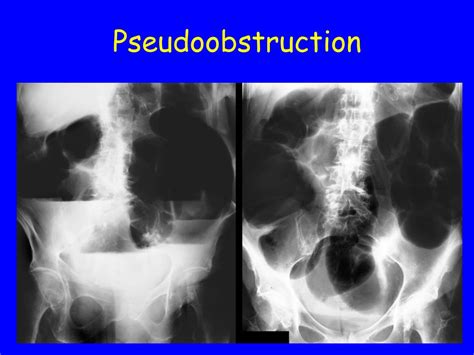 PPT - “Functional” Bowel Disorders PowerPoint Presentation, free ...