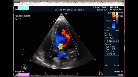 Viewing a cardiac ultrasound doppler (Dicom multiframe) on medview ...