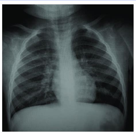 Chest X-ray with pulmonary hyperinflation. | Download Scientific Diagram