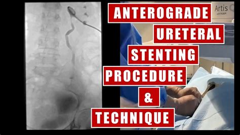 Trans-nephrostomy Ureteral Stent placement under fluoroscopy guidance ...