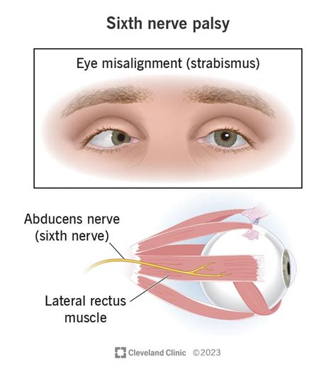 Sixth Nerve Palsy: Causes, Symptoms & Treatment