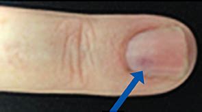 3 Cases of Glomus Tumor—An Unusual Cause of Hand Pain - The Rheumatologist