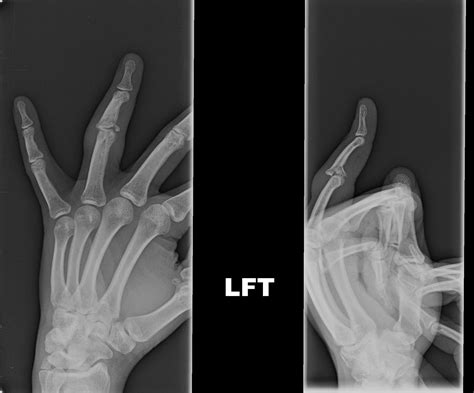 Broke my ring finger its healing misaligned at the joint. (XRay is 3 ...