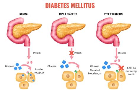 Free Vector | Realistic pancreas anatomy insulin diabetes mellitus ...