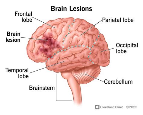 Brain Lesions: What They Are, Causes, Symptoms & Treatment