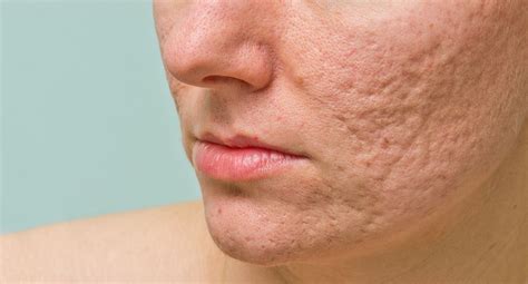 Types of Acne Scars and How to Remove Acne Scars - Eucerin