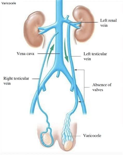 Varicocele - What is it, symptoms, treatment, embolization