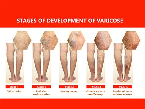 How Do Venous Ulcers Form? And Other Questions - Denver Vein Center