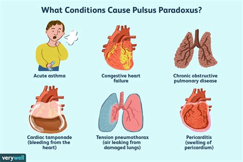 ¿Qué es Pulsus Paradoxus? - Medicina Básica