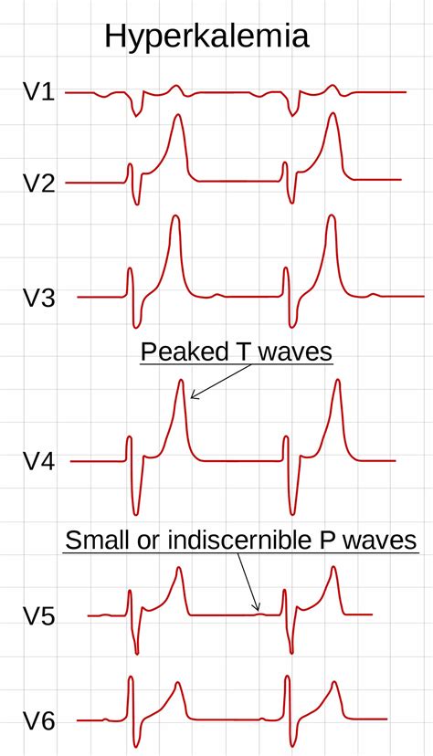 Hyperkalemia ecg findings - uppikol