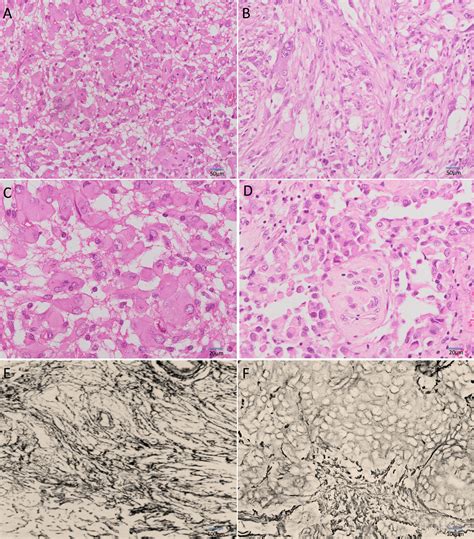 The evolution of pleomorphic xanthoastrocytoma: from genesis to ...