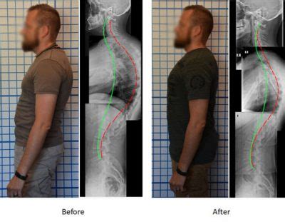 Case Study Kyphosis Treatment in Adults (Before & After)