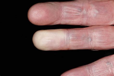 Raynaud's - NHS.UK