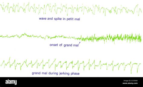 The seizures of epilepsy are dramatically demonstrated by the EEG Stock ...