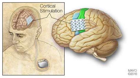 Study: Continuous electrical brain stimulation helps patients with ...