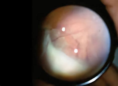 Pars Planitis Treatment | Retinal Consultants Medical Group