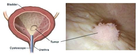 Bladder Cancer: Causes, Signs, Symptoms, Diagnosis and Stages | Saint ...