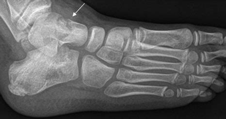 Clinical Practice Guidelines : Talus Fractures: Emergency Department