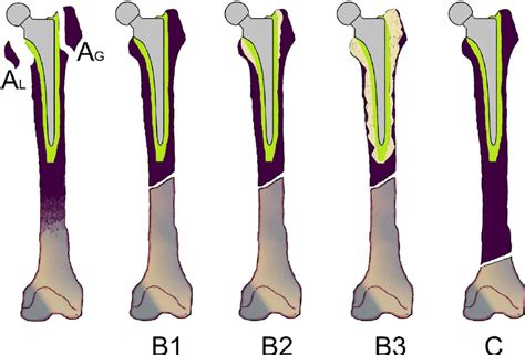 Vancouver classification of postoperative periprosthetic femur ...