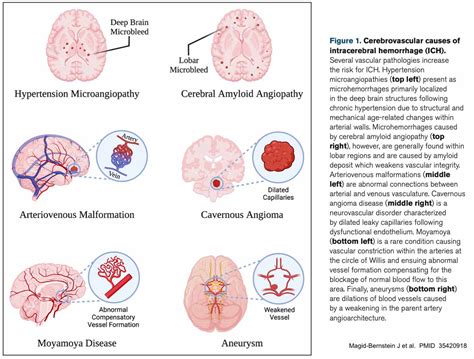 Intraparenchymal Hemorrhage Vs Subarachnoid Hemorrhage