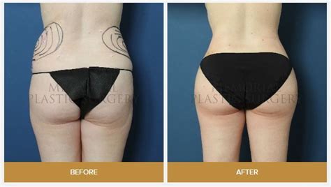 10 best images about Brazilian Buttock Augmentation on Pinterest | Los ...