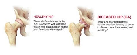 Anterior Hip Replacement: Fast Recovery & Expert Care | Dr. Bryant Bonner