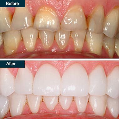 Porcelain Dental Crowns in Yonkers NY | Procedure & Cost