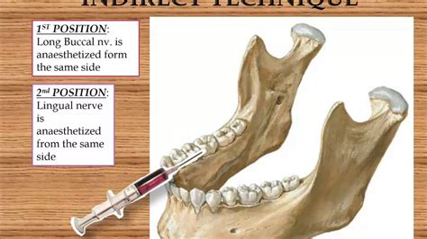 Inferior Alveolar Nerve Block - YouTube