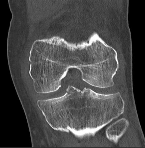 Tibial Intercondylar Eminence