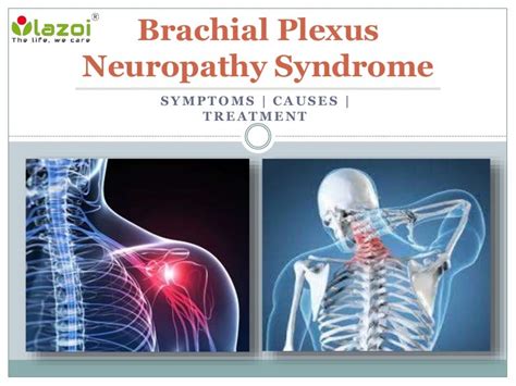 Brachial Plexus Neuropathy Syndrome : Causes, Symptoms, Daignosis and…