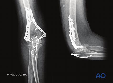 ORIF Of Distal Humerus Fractures With Modern Pre-contoured, 57% OFF