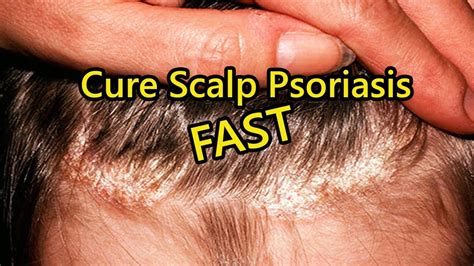 Psoriasis Scalp Treatment