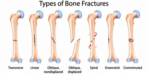 Long bone anatomy, structure, parts, function and fracture types