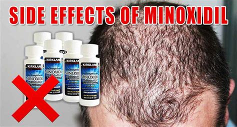 The Good, The Bad, And The Side Effects Of Minoxidil - Lewigs