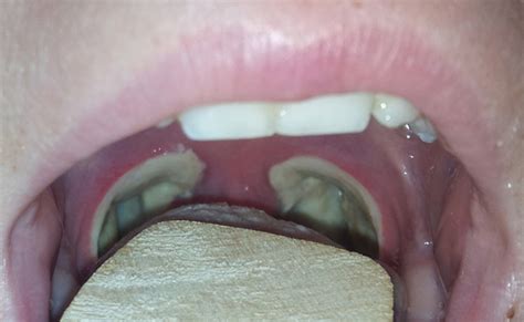 Tonsillectomy And Adenoidectomy Post Op