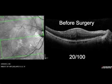 Macular Pucker | Scott E. Pautler, M.D. Tampa