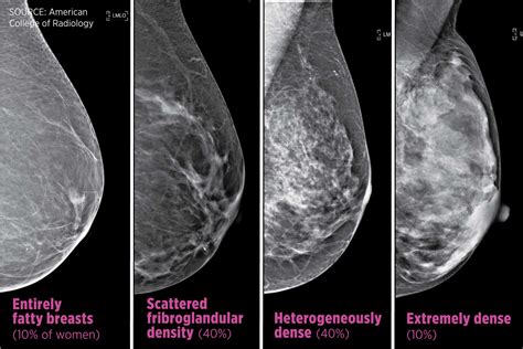 Breast Cancer Mammogram