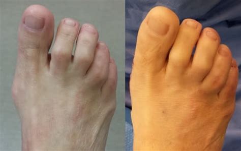 Minimally Invasive Bunion Surgery Pictures Before and After Operation ...