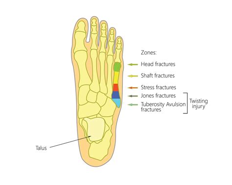 Fifth Metatarsal Fractures - Upswing Health | Upswing Health