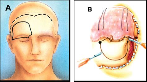 Surgical Treatment of Meningiomas | Neupsy Key