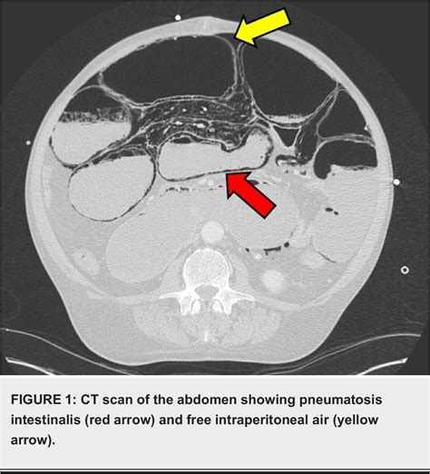 Figure 1 from A Rare Case of Chronic Small Bowel Pseudo-Obstruction ...