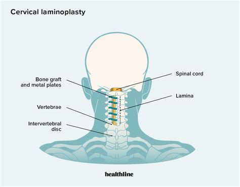 Laminoplasty Surgery: Procedure, Benefits, Risks, Recovery