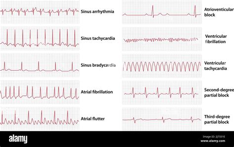 Ecg Abnormalities Chart Oficial Online | www.gbu-hamovniki.ru