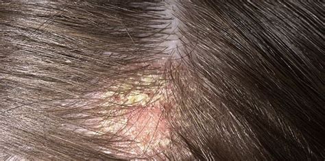 How to treat scalp scabs - Kelture Aveda | Singapore Leading Hair Salon